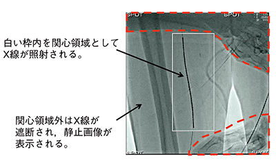 図4　DoseRite SpotFluoroの実例