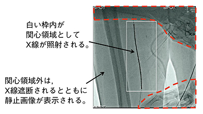 図3　DoseRite SpotFluoroの実例