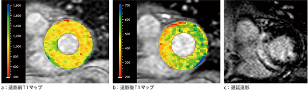 図3　造影前後のT1マップと遅延造影の画像例