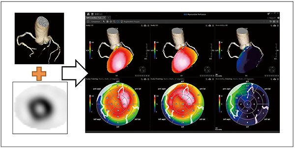 図7　NM Cardiac Fusion使用画像