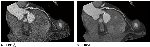 図3　FBP法とFIRST再構成で得られたCTCA画像