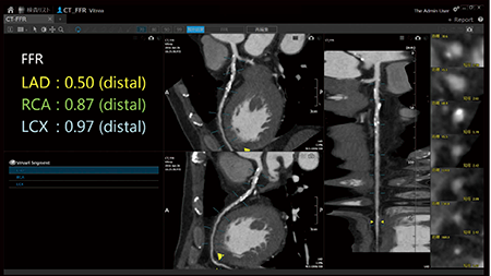 図4　SURECardio CTFFRによるFFRの算出
