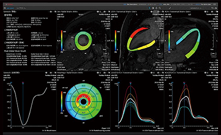 図5　MR Wall Motion Trackingによる心筋strain解析