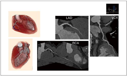 図1　HR 73 bpm 1 Beat Cardiac CTA：慢性完全閉塞（CTO）石灰化症例