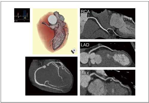 図2　Low Dose 1 Beat Cardiac CTA（0 . 59 mSV）