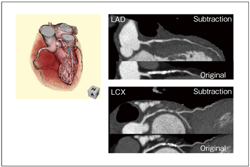 図3　 冠動脈サブトラクション（W.I.P.）