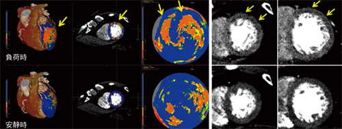 図4　 myocardial CT perfusion解析例（左冠動脈狭窄症例）