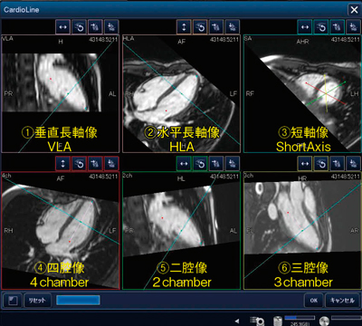 図2　ワンボタンで心臓断面設定をアシスト