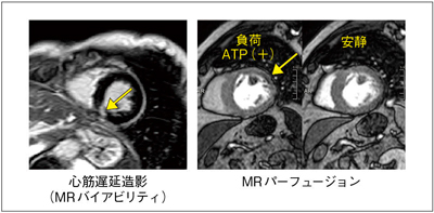 図4　遅延造影（MRバイアビリティ）と心筋パーフュージョン