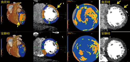 図1　CT Myocardial Perfusion解析例：左冠動脈狭窄症例