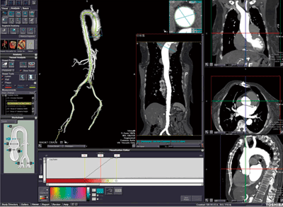 図4　CT TAVR Analysis解析例