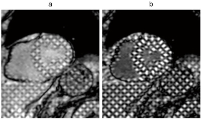 図1　タギング画像 拡張期（a）で認められる左室心筋の格子状のタグが収縮期（b）で歪んでいる。この歪みで収縮の程度を評価する。