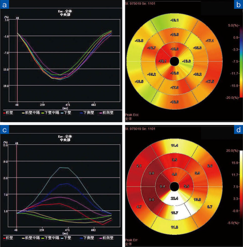 図5　ストレインカーブとブルズアイ画像 PACSの読影サーバーに送られるストレイン解析データ。circumferential方向（Ecc）のストレインカーブ（a）とブルズアイ画像（b）、radial方向（Err）のストレインカーブ（c）とブルズアイ画像（d）。表示のストレインカーブは中央部のものだが、心基部、心尖部のストレインカーブも転送される。健常者の解析データだが、radial方向では区域でピークストレインにばらつきがあるのがわかる。