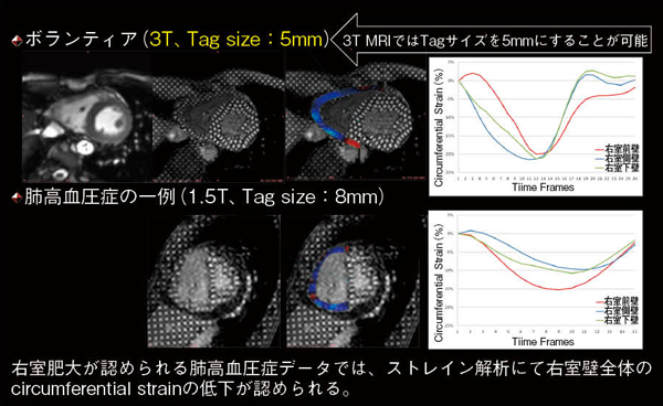 図4　ストレイン解析の右室への応用