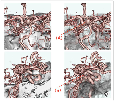 図3　頭蓋底内の動脈瘤におけるサブトラクション