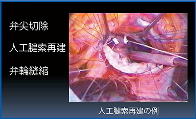 図3　僧帽弁形成術の方法