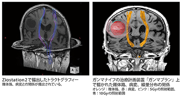 Ziostation2のMRトラクトグラフィーのガンマナイフ治療への応用