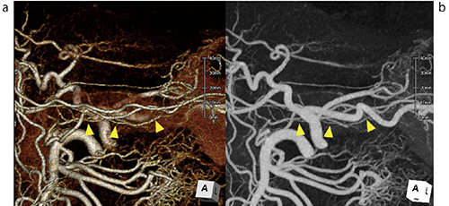 図4　横行膵動脈（transverse pancreatic artery）の描出（▲）