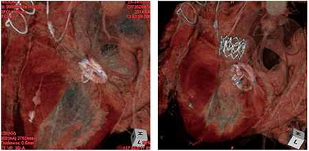 図2　僧帽弁位に人工弁が留置されたTAVI弁留置困難例での4D解析