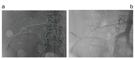 図1　仮想透視画像（Virtual Fluoroscopic Image）