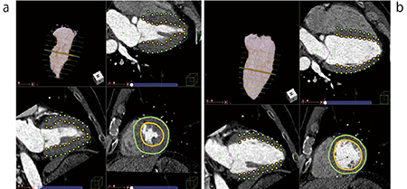 図4　CT心機能解析2での抽出結果 a：拡張期（ED）　b：収縮期（ES） 心筋の抽出精度が高く正確にトレースできている。