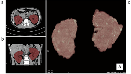 図6　多発性囊胞腎の容量計測 a：axial　b：coronal　c：VR