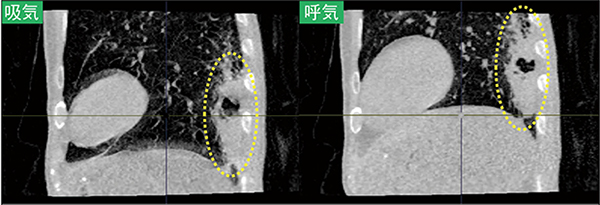 図1　肺がんの呼吸ダイナミックCT（抜粋）