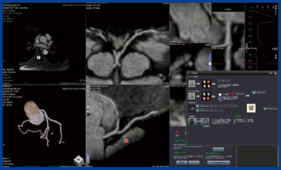 図1　MR冠動脈解析2によるMRCAの自動解析