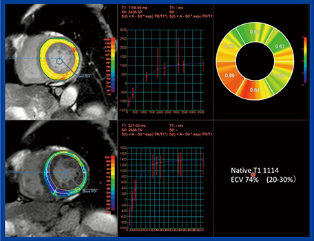 図2　MR心筋T1マッピングを用いたnative T1，ECV解析