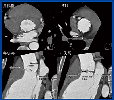 図5　大動脈弁逆流症例の大動脈基部，弁尖長，弁尖高の計測