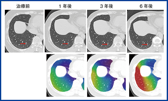 図4　50歳代，女性，特発性肺線維症（IPF）