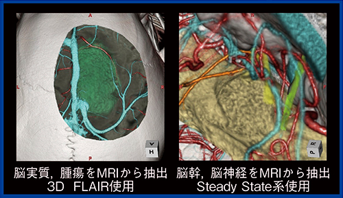 図3　CT・MRIのFusion Imageによる手術支援画像