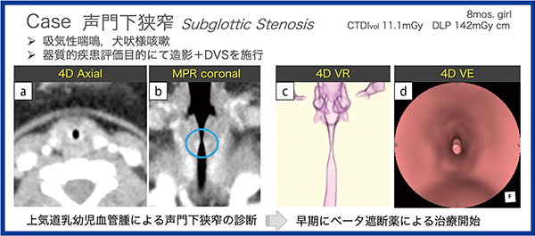 図1　症例：声門下狭窄のDynamic Volume Scanによる動態撮影