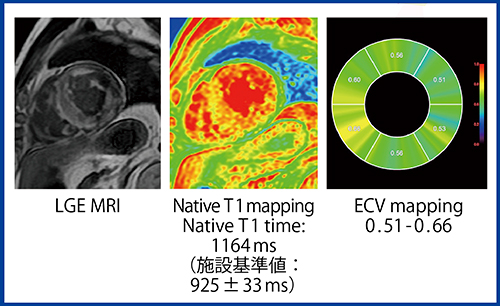 図3　T1マッピングによる心アミロイドーシス評価