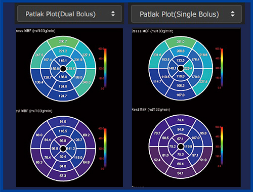 図5　‌Dual Bolus法（左）とSingle Bolus法（右）のMBF解析結果