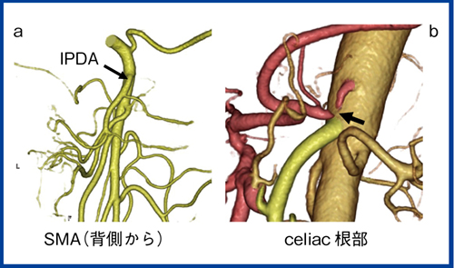 図3　膵頭十二指腸切除前における観察ポイント