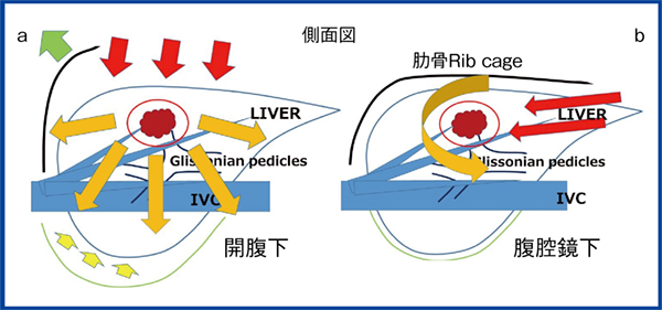 図1　開腹肝切除術と腹腔鏡下肝切除術