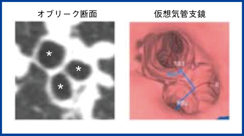 図2　オブリーク断面の使いどころ：描いたルートを「見るとき」 気管支を適切な角度で輪切りにすることで仮想気管支鏡画像と同じような断面が得られる。