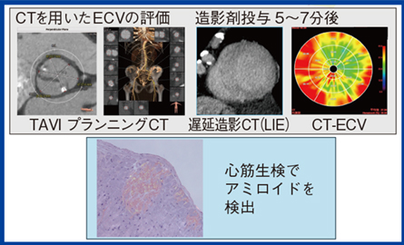 図4　TAVIプランニング時のCT-ECV解析