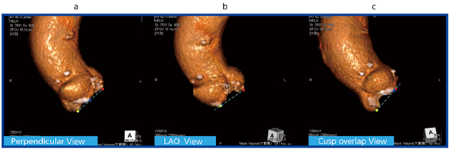 図3　X線透視角 a：perpendicular view b：LAO view c：cusp overlap view