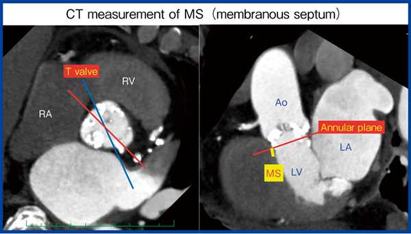 図4　膜性中隔（membranous septum）の計測 膜性中隔は弁輪から筋性中隔までの距離として計測する。