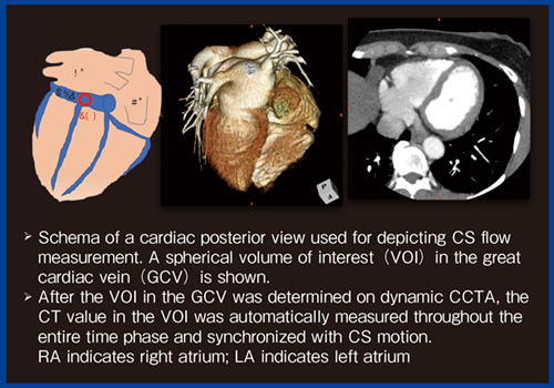 図5　冠静脈洞（coronary sinus）フローの計測