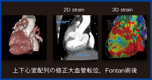 図6　PhyZiodynamicsによるCTストレイン解析