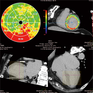 心筋ECV解析