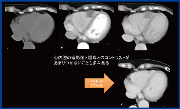 図3　転移性腫瘍