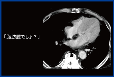 図4　Lipomatous hypertrophy of the interatrial septum（LHIS）