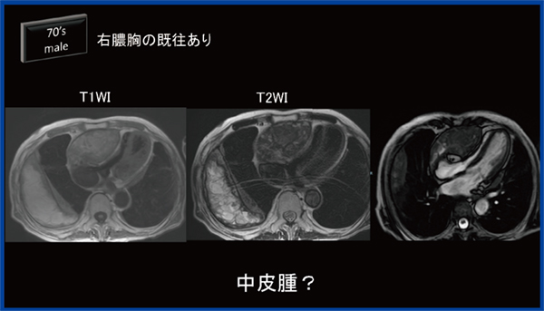 図7　Chronic expanding hematoma（CEH）