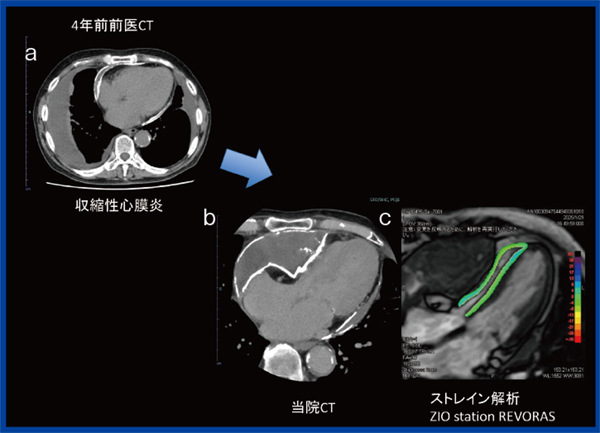 図8　図7と同一症例のCTおよびMR心筋ストレイン解析画像