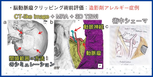 図5　脳神経外科領域での使用：脳動脈瘤クリッピング術前評価