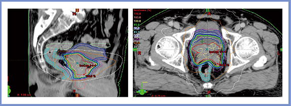 図1　症例1：前立腺癌 1 Arc RapidArc IMRT 70Gy/35Fr/7w